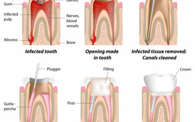 Let’s get past the “Fake News” about Root Canals