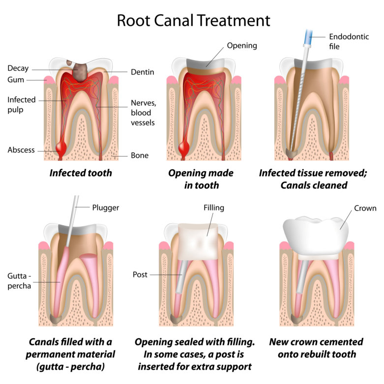 Root Canal Treatment | Briter Dental